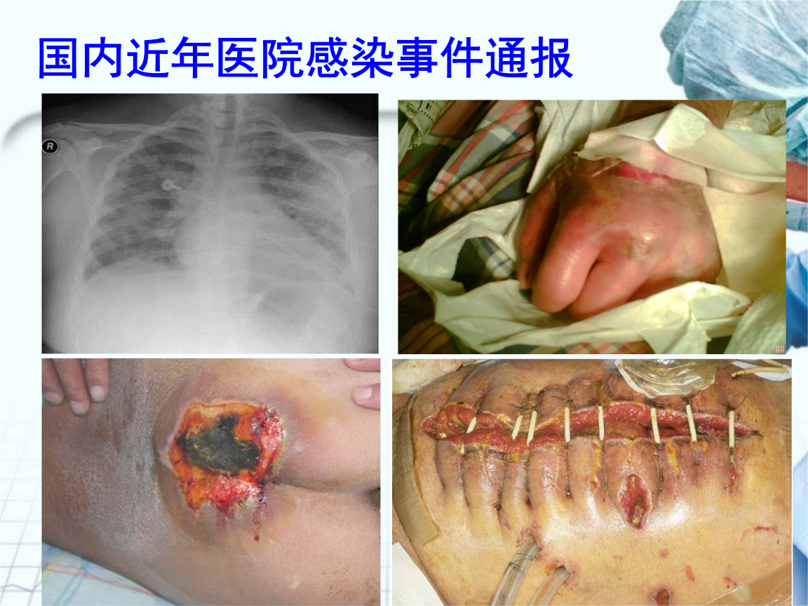 近国内医院感染案例整理汇总.解读.ppt